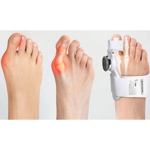 Orteza na vbočený palec s kloubem Bandáž Hallux Valgus